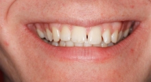 gaps between upper front teeth