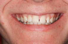 gaps between upper front teeth